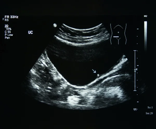 Ultrasonido de una mujer anormal en el riñón — Foto de Stock