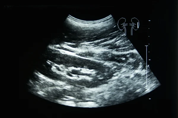 Ultrasound film of a woman left kidney — Stock Photo, Image