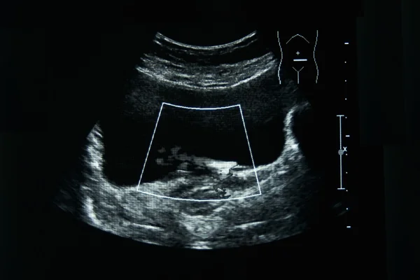 Pellicola ad ultrasuoni di una donna uretere sinistro anormale — Foto Stock