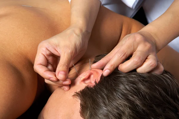 Akupunktura ucha — Zdjęcie stockowe