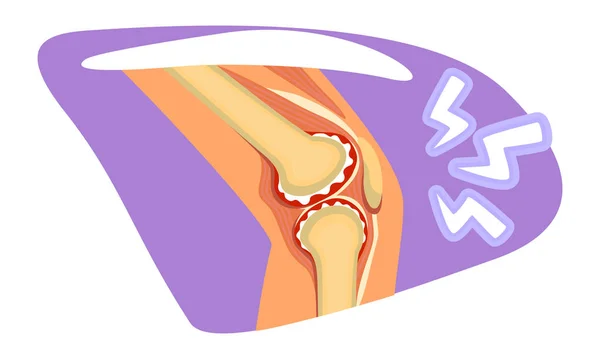 Knee Pain Vector Isolated Illustration Ruptured Ligament Risk Flat Sticker — Stock Vector