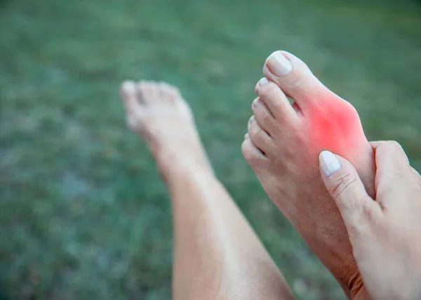 Woman feeling Discomfort outdoor taking off shoes cause Bone arthritis Pain. Massage bare foot  Painful Bunion.Red spot on feet Bunion Pain