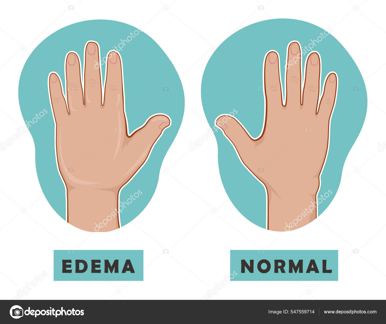 Mano hinchada y mano normal. Edema y linfedema. Ilustración vectorial