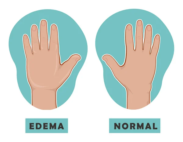 Mano hinchada y mano normal. Edema y linfedema. Ilustración vectorial de la enfermedad antes-después. — Vector de stock