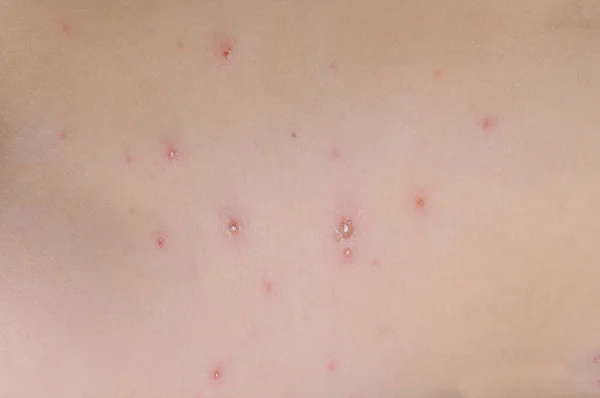近くの子供の皮膚の水痘 — ストック写真