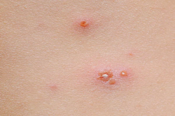 近くの子供の皮膚の水痘 — ストック写真