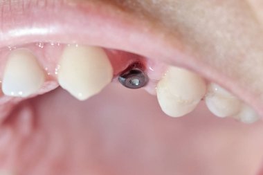 Diş azı dişi implantı olan gerçek ağız..