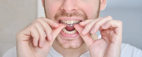 Pria muda latin tak dikenal menyesuaikan tali kekang ortodontik yang tak terlihat aligner. — Stok Foto