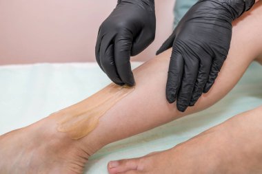 Kadın vücudundan şekerleme yapmak için şeker macunuyla kılı çıkarma işlemi. Kozmetik prosedür..