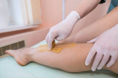 Bacaklarda gereksiz tüyleri çıkarmak. Bir güzellik salonunda prosedür şekerleme. Şeker dökülmesi. Tüy dökücü şeker hamuru