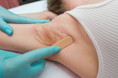 Depilation and epilation of the female armpit with liquid sugar paste. The beautician's hand applies wax paste to the armpit. The concept of smooth armpits