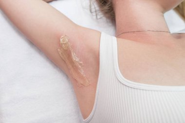 Shugaring concept. Close-up of a woman's armpit with sugar paste applied for hair removal.
