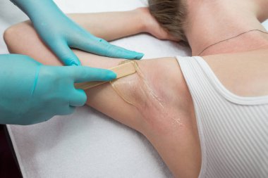 Depilation and epilation of the female armpit with liquid sugar paste. The beautician's hand applies wax paste to the armpit. The concept of smooth armpits