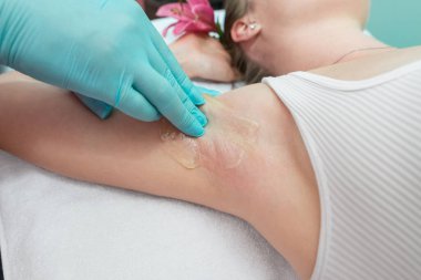 Depilation and epilation of the female armpit with liquid sugar paste. The beautician's hand applies wax paste to the armpit. The concept of smooth armpits