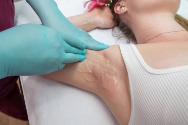 Depilation and epilation of the female armpit with liquid sugar paste. The beautician's hand applies wax paste to the armpit. The concept of smooth armpits