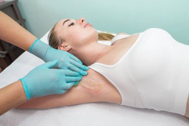 Depilation and epilation of the female armpit with liquid sugar paste. The beautician's hand applies wax paste to the armpit. The concept of smooth armpits