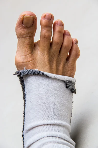 Изолированная нога с бедным носком — стоковое фото