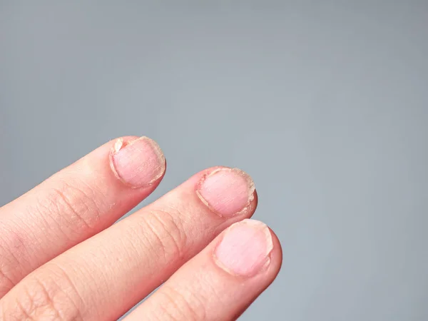 Mano Niño Con Uñas Débiles Quebradizas Aislada Sobre Fondo Gris — Foto de Stock