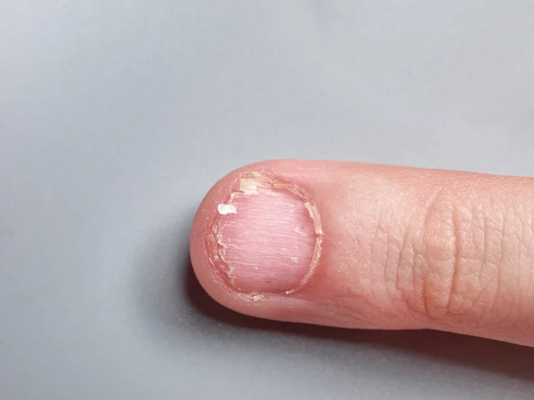 Uña Niño Años Con Una Enfermedad Las Uñas Uñas Muy — Foto de Stock