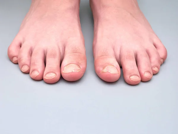 一个患指甲疾病的9岁男孩的脚趾甲 非常弱或易碎的指甲 在灰色背景下隔离 有复制空间 — 图库照片