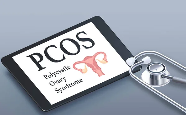 Pcos 多嚢胞性卵巣症候群 子宮テキストと聴診器でタブレット上のアイコン 灰色の背景 医療ポスター 高品質の写真 — ストック写真