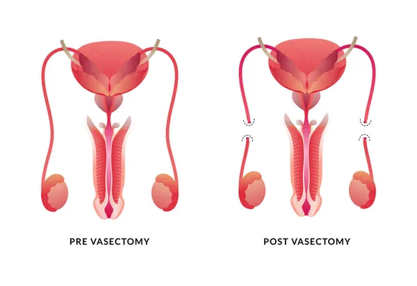 Vasectomia Maschile Anatomia Del Sistema Riproduttivo Maschile — Vettoriale Stock