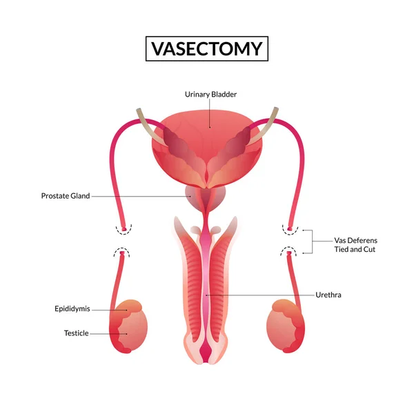 Vasectomia Masculina Anatomia Sistema Reprodutor Masculino — Vetor de Stock