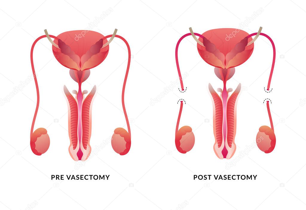 Male Vasectomy. Anatomy of the Male Reproductive System.