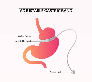 ayarlanabilir mide bandı, Tap Band Cerrahi Diyagramı Tıbbi İllüstrasyon.