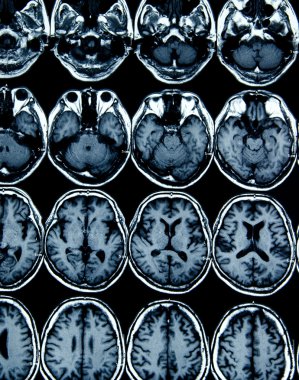 Tanı için beyin MRI tarama görüntü