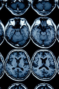 Tanı için beyin MRI tarama görüntü