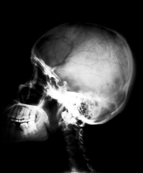 Radiografia del cranio — Foto Stock