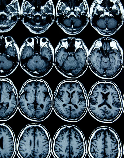 診断のための脳の mri スキャン画像 — ストック写真
