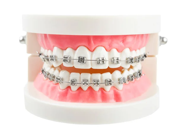 Teeth Model Wire Dental Braces Isolated White Background Clipping Path — Stock Photo, Image