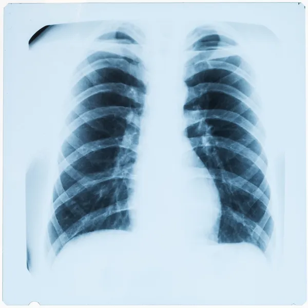 X-ray of male chest after pneumonia — Stock Photo, Image