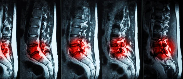 Ressonância magnética (RM) de coluna lombo-sacral mostr — Fotografia de Stock