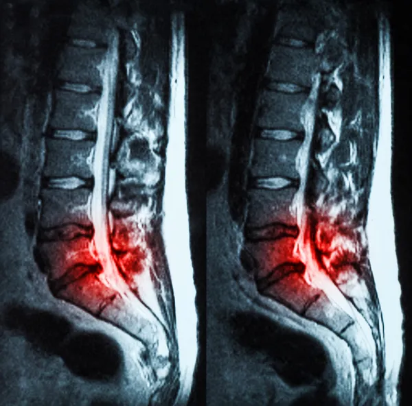 Magnetic resonance imaging (MRI) of lumbo-sacral spines demonstr — Stock Photo, Image