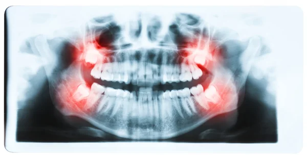 Immagine radiografica panoramica di denti e bocca con tutti e quattro i molari ve — Foto Stock