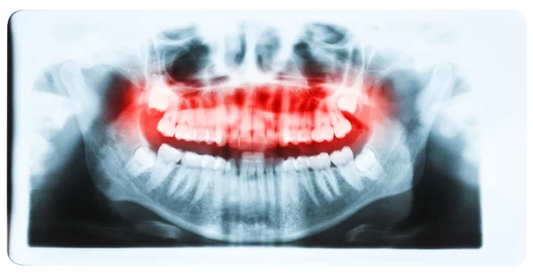 Imagen de rayos X panorámica de dientes y boca con los cuatro molares ve — Foto de Stock