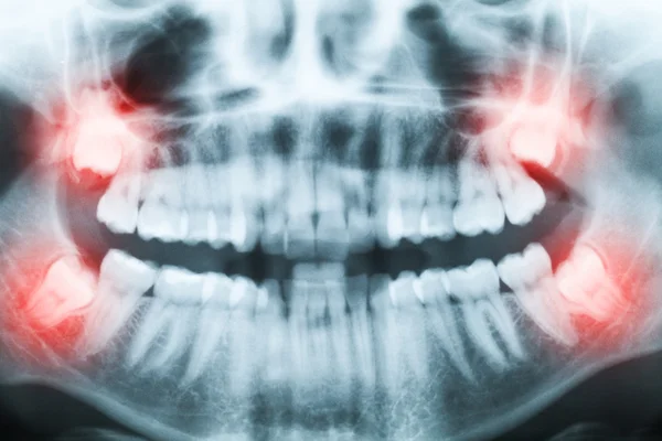 Primer plano de la imagen de rayos X de dientes y boca con los cuatro molares v —  Fotos de Stock