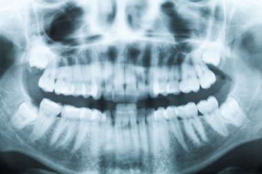 diş ve ağız ile tüm dört büyük azı dikey closeup x-ray görüntüsü