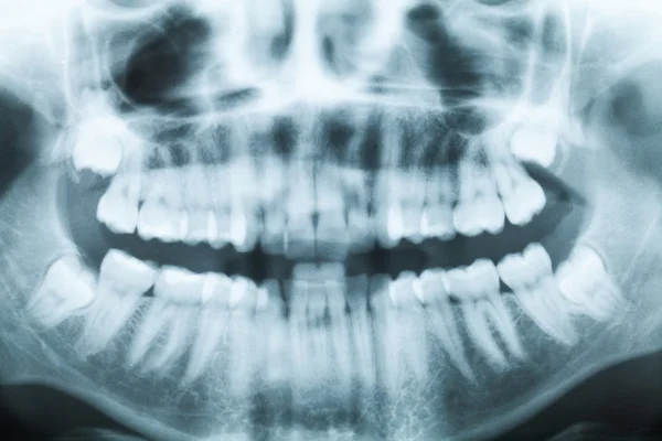 Closeup x-ray image of teeth and mouth with all four molars vert — Stock Photo, Image