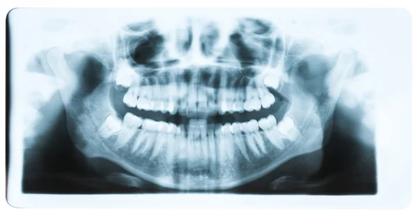 Imagen de rayos X panorámica de dientes y boca con los cuatro molares ve —  Fotos de Stock