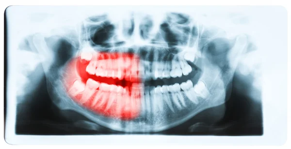 Panorama röntgenbild av tänder och mun med alla fyra molarer ve — Stockfoto