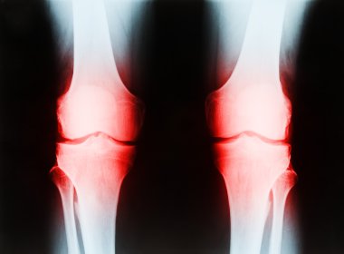 x-ışını tibia ve FIB gösteren bir kıdemli erkek sağ ve sol diz