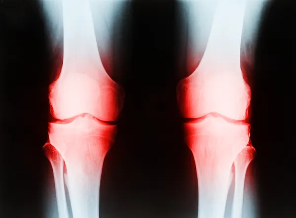 X-ray dari laki-laki senior kanan dan kiri lutut menunjukkan tibia dan serat — Stok Foto