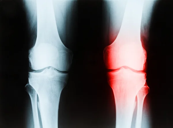 Radiografía de una rodilla derecha e izquierda masculina mayor que muestra tibia y fibrilación — Foto de Stock