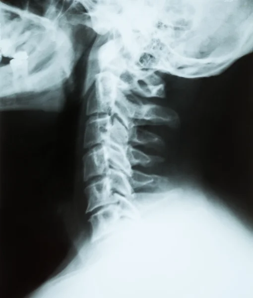 Рентген шейного отдела позвоночника (шеи) пациента старшего возраста, вид f — стоковое фото