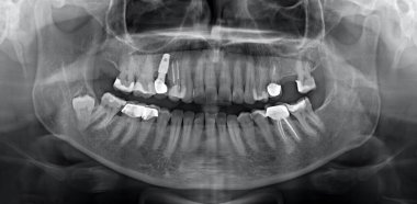 Panoramik çene röntgeni, diş implantları, diş dolguları ve çene kemiğindeki yirmilik dişleri.