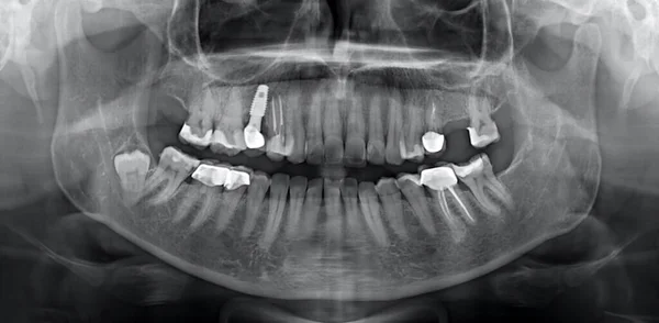 Panoramik çene röntgeni, diş implantları, diş dolguları ve çene kemiğindeki yirmilik dişleri.